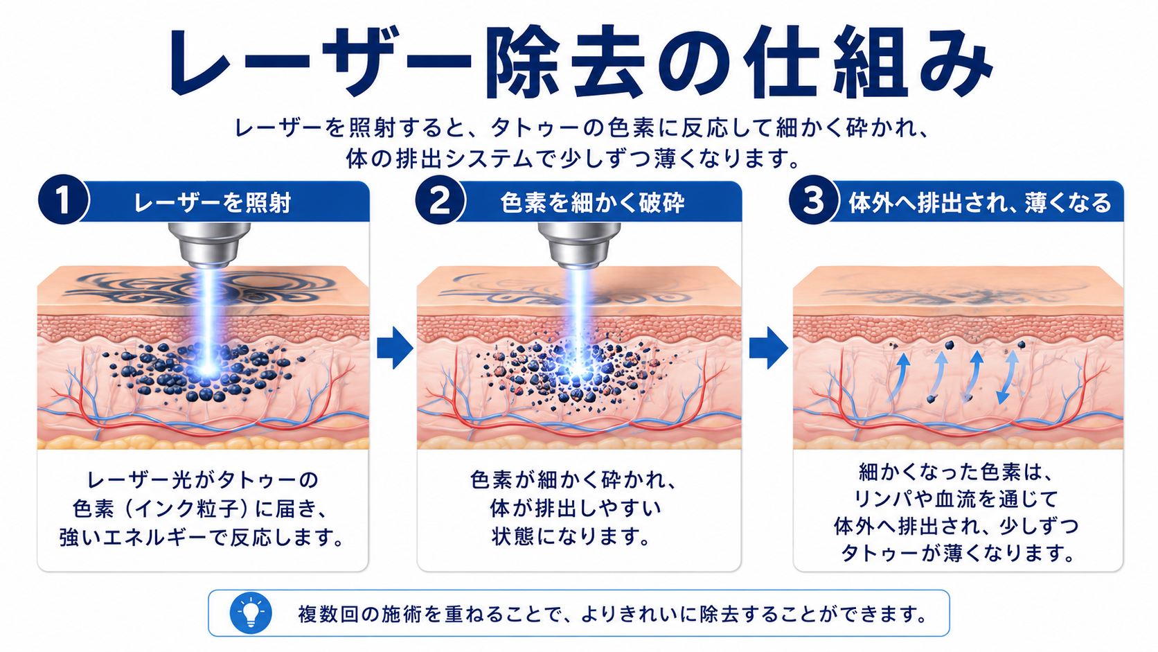 タトゥーレーザー除去の仕組み